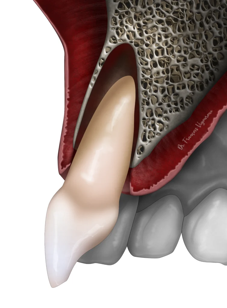 Extrusion